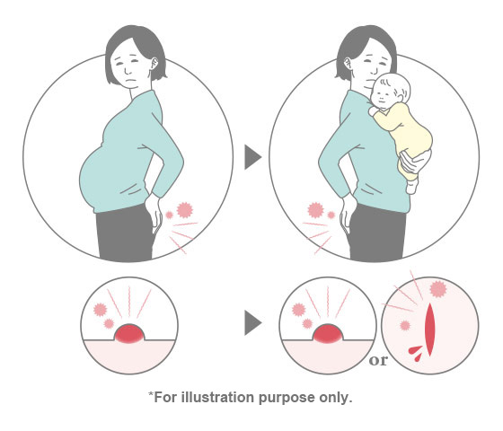 Post-Pregnancy Piles Treatment