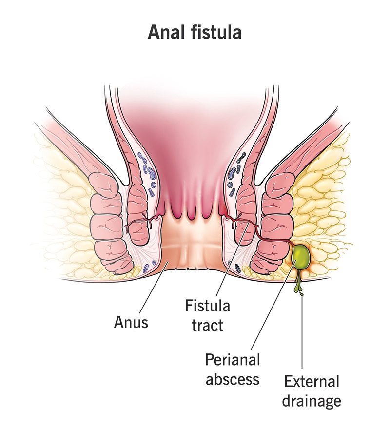Fistula
